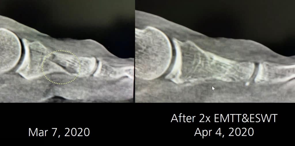 2 treatments with ESWT and EMTT